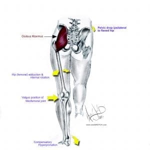 Knee Valgus collapse